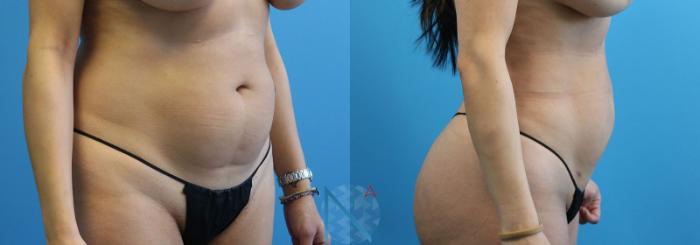 Before & After Liposuction Case 109 View 3 View in Raleigh, NC