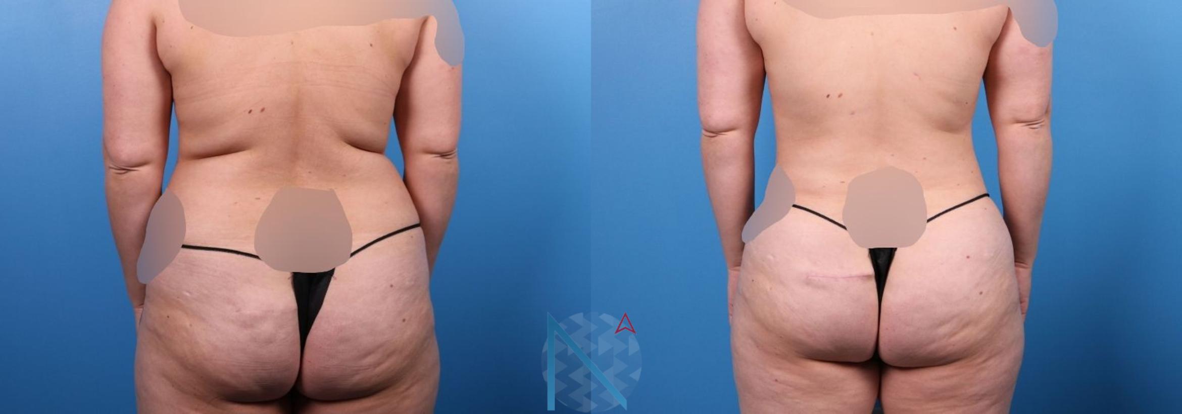 Before & After Liposuction Case 110 View 1 View in Raleigh, NC