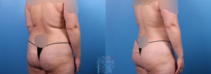 Before & After Liposuction Case 110 View 2 View in Raleigh, NC