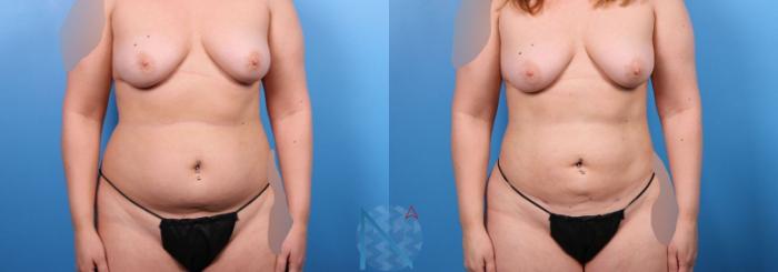 Before & After Liposuction Case 110 View 3 View in Raleigh, NC