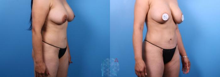 Before & After Liposuction Case 111 View 2 View in Raleigh, NC