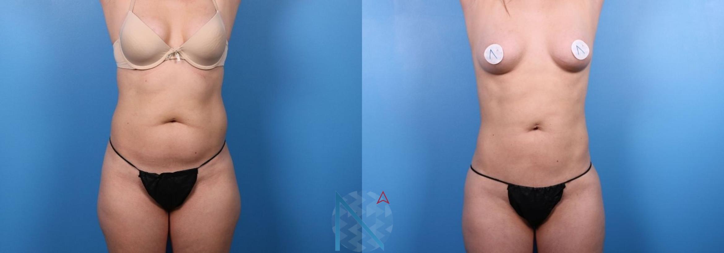 Before & After Liposuction Case 112 View 1 View in Raleigh, NC