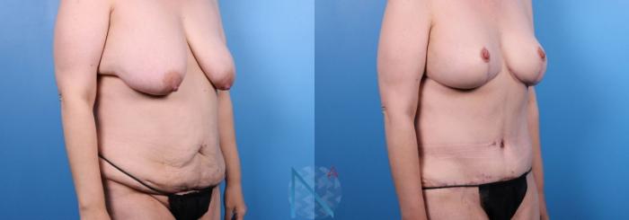 Before & After Liposuction Case 113 View 2 View in Raleigh, NC