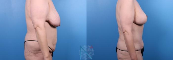 Before & After Liposuction Case 113 View 3 View in Raleigh, NC