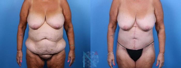 Before & After Liposuction Case 114 View 1 View in Raleigh, NC