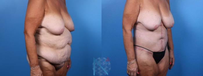 Before & After Liposuction Case 114 View 2 View in Raleigh, NC