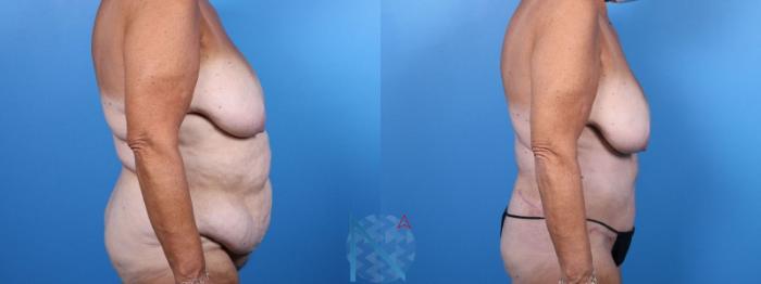 Before & After Liposuction Case 114 View 3 View in Raleigh, NC