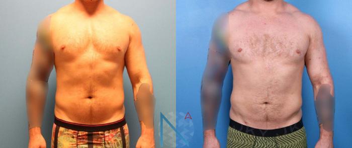 Before & After Liposuction Case 115 View 1 View in Raleigh, NC