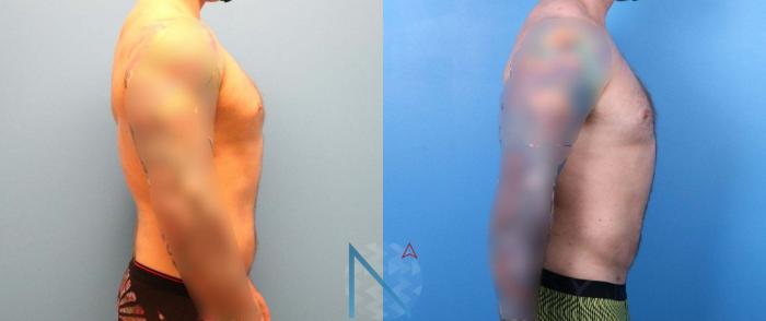 Before & After Liposuction Case 115 View 3 View in Raleigh, NC