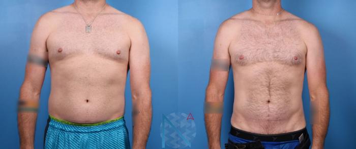 Before & After Liposuction Case 116 View 1 View in Raleigh, NC