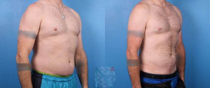 Before & After Liposuction Case 116 View 2 View in Raleigh, NC