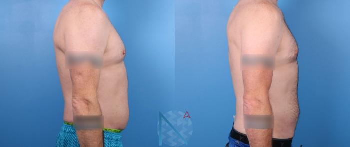 Before & After Liposuction Case 116 View 3 View in Raleigh, NC