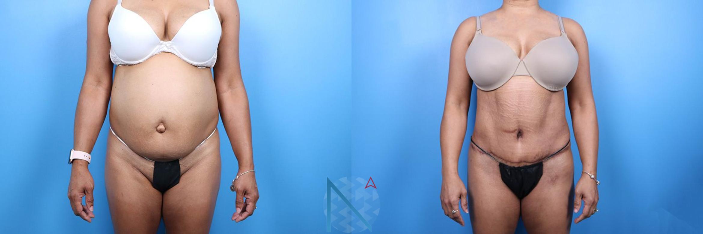 Before & After Liposuction Case 117 View 1 View in Raleigh, NC