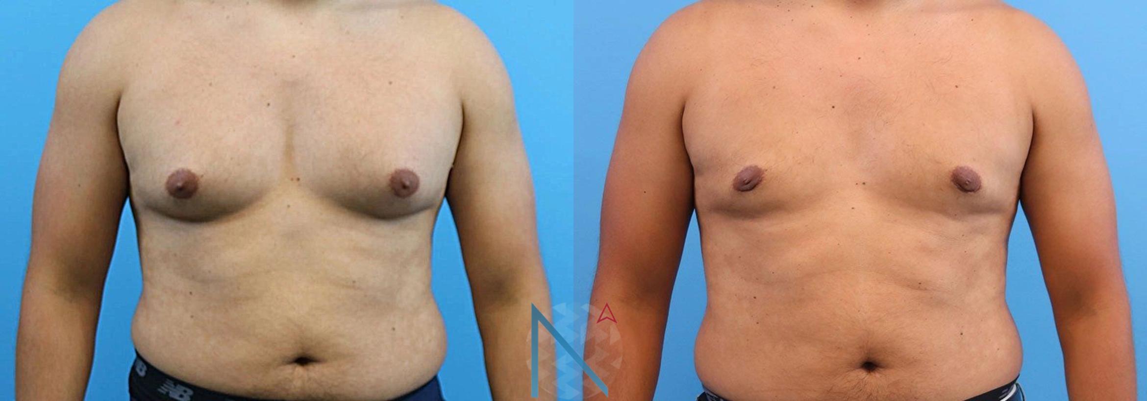 Before & After Male Breast Reduction Case 168 View 1 View in Raleigh, NC