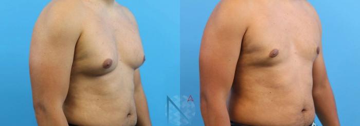 Before & After Male Breast Reduction Case 168 View 2 View in Raleigh, NC