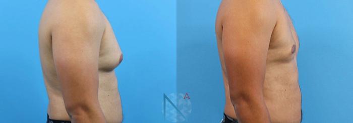 Before & After Male Breast Reduction Case 168 View 3 View in Raleigh, NC