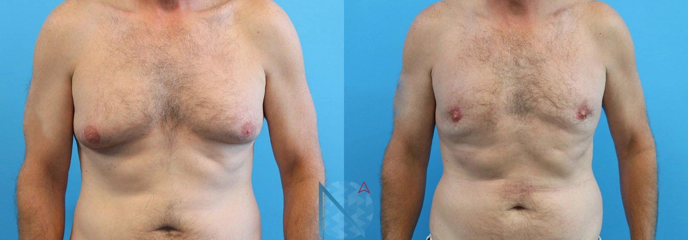 Before & After Male Breast Reduction Case 169 View 1 View in Raleigh, NC