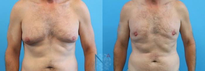 Before & After Male Breast Reduction Case 169 View 1 View in Raleigh, NC