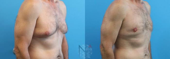 Before & After Male Breast Reduction Case 169 View 2 View in Raleigh, NC