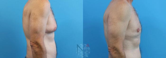 Before & After Male Breast Reduction Case 169 View 3 View in Raleigh, NC