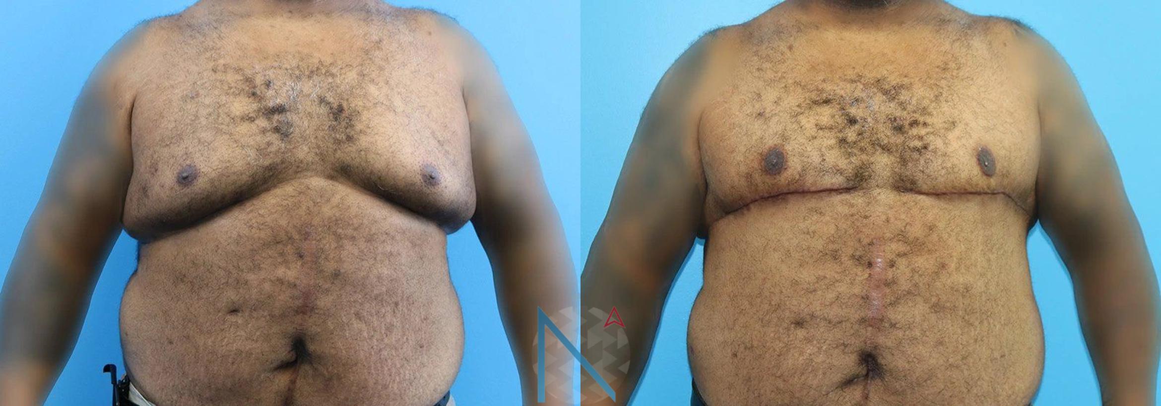 Before & After Male Breast Reduction Case 170 View 1 View in Raleigh, NC