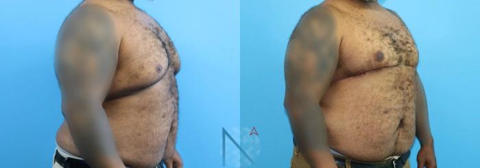 Before & After Male Breast Reduction Case 170 View 2 View in Raleigh, NC