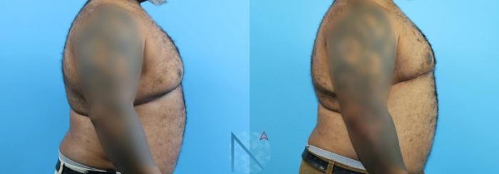 Before & After Male Breast Reduction Case 170 View 3 View in Raleigh, NC