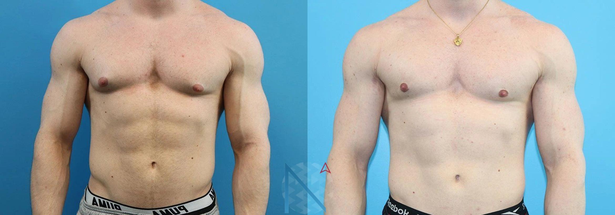 Before & After Male Breast Reduction Case 171 View 1 View in Raleigh, NC