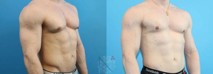 Before & After Male Breast Reduction Case 171 View 2 View in Raleigh, NC