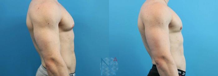 Before & After Male Breast Reduction Case 171 View 3 View in Raleigh, NC