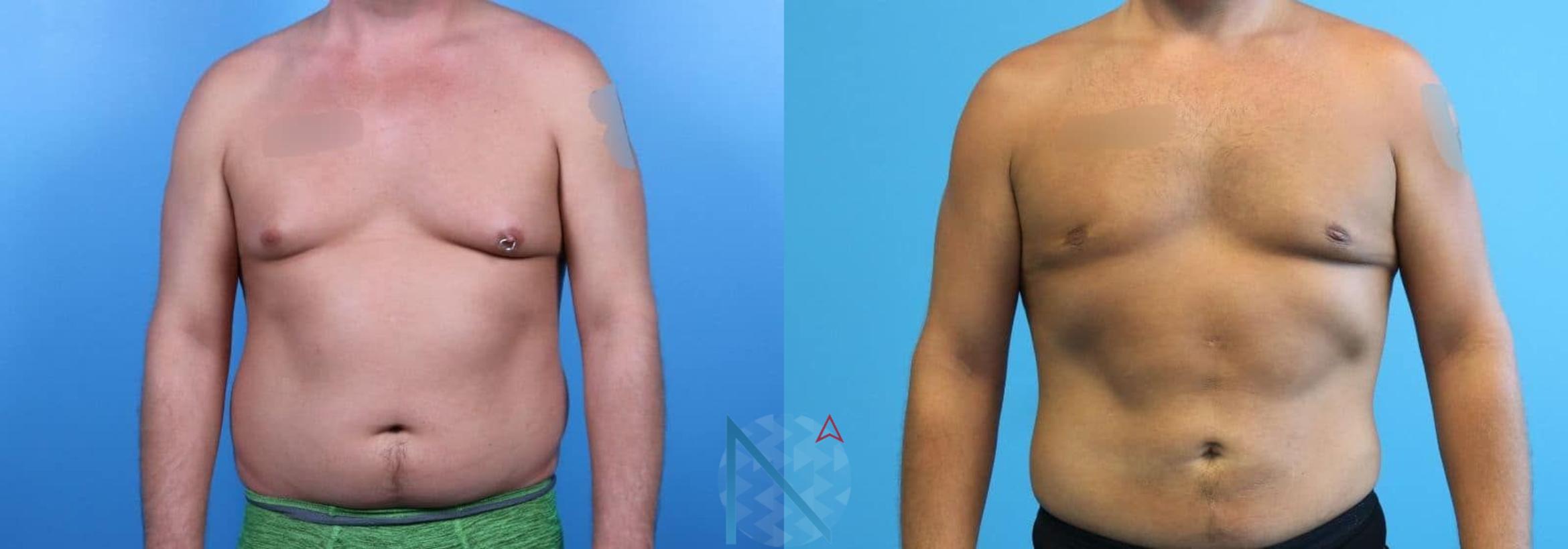 Before & After Male Breast Reduction Case 172 View 1 View in Raleigh, NC