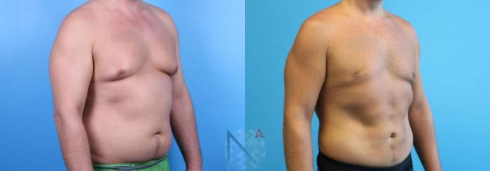 Before & After Male Breast Reduction Case 172 View 2 View in Raleigh, NC