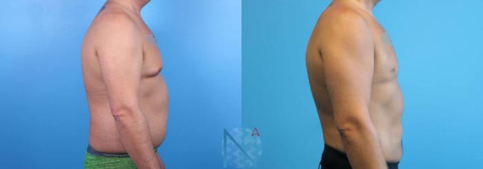 Before & After Male Breast Reduction Case 172 View 3 View in Raleigh, NC