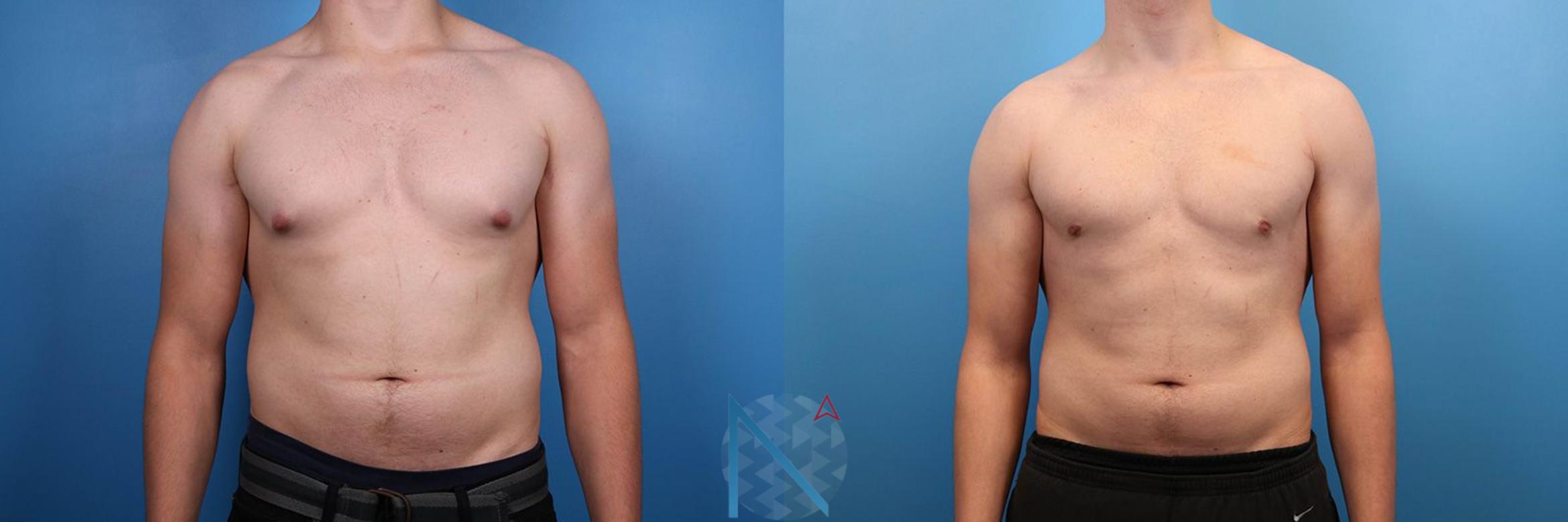 Before & After Male Breast Reduction Case 173 View 1 View in Raleigh, NC