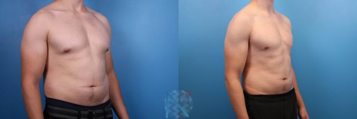 Before & After Male Breast Reduction Case 173 View 2 View in Raleigh, NC