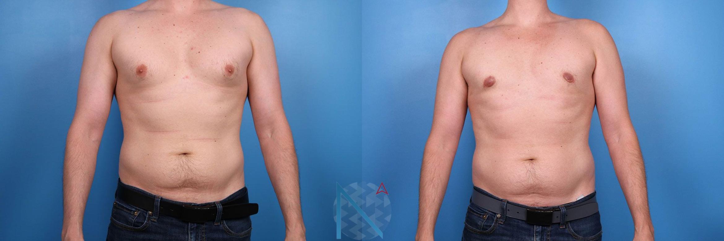 Before & After Male Breast Reduction Case 174 View 1 View in Raleigh, NC