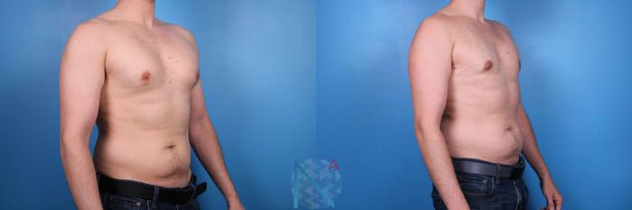 Before & After Male Breast Reduction Case 174 View 2 View in Raleigh, NC