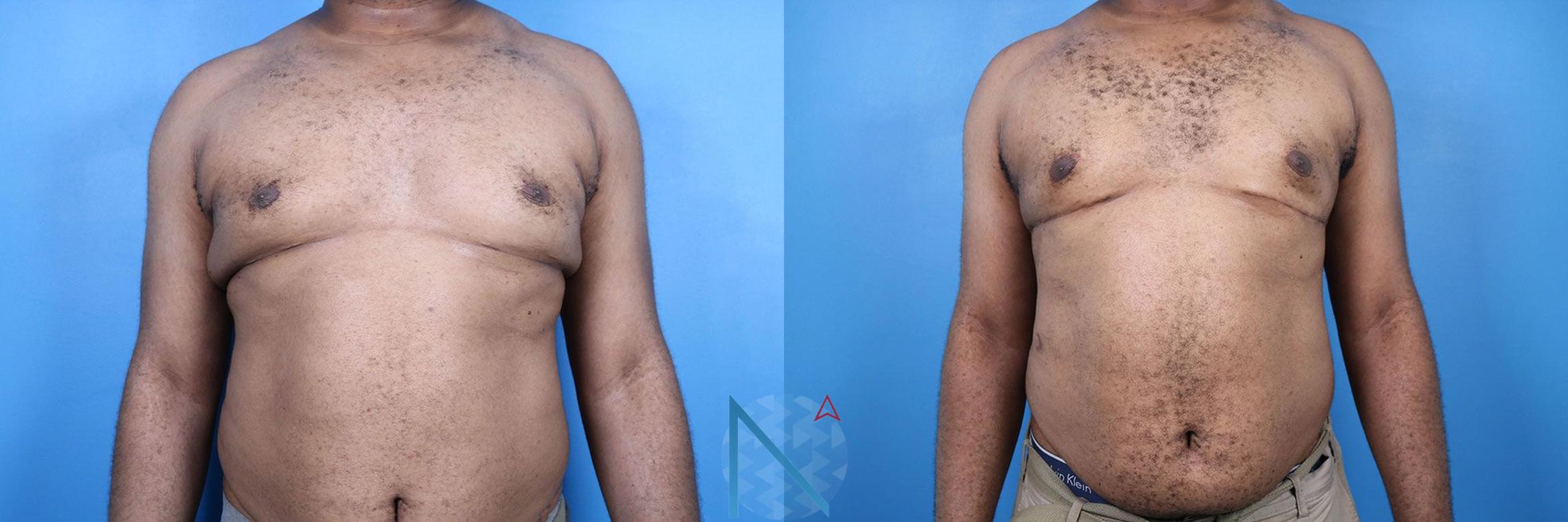 Before & After Male Breast Reduction Case 175 View 1 View in Raleigh, NC