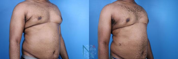 Before & After Male Breast Reduction Case 175 View 2 View in Raleigh, NC