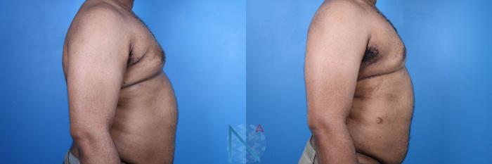 Before & After Male Breast Reduction Case 175 View 3 View in Raleigh, NC