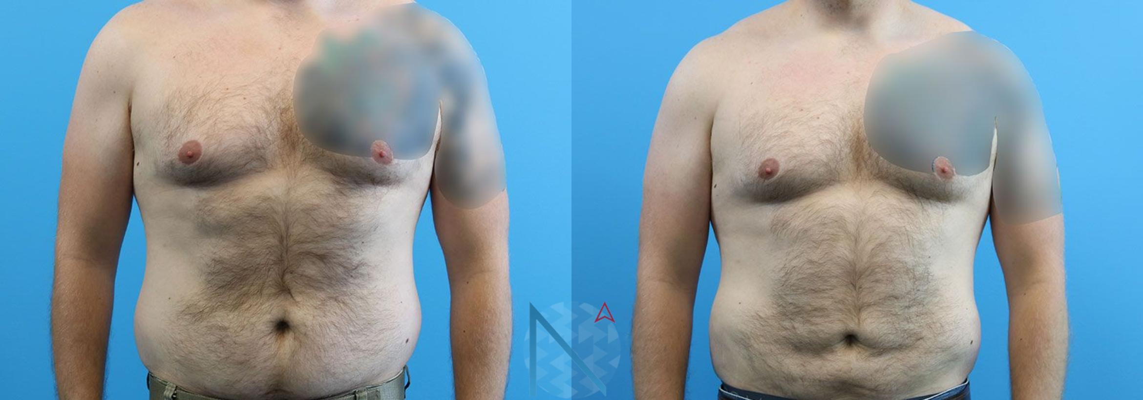 Before & After Male Liposuction Case 162 View 1 View in Raleigh, NC