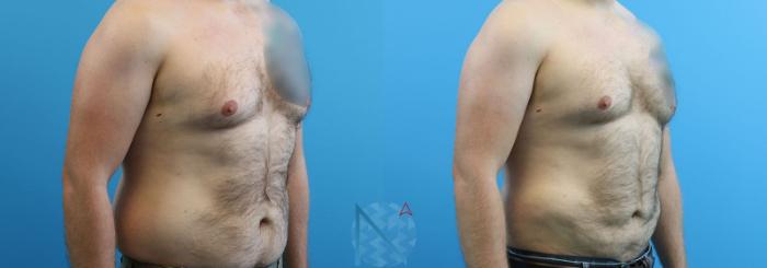 Before & After Male Liposuction Case 162 View 2 View in Raleigh, NC