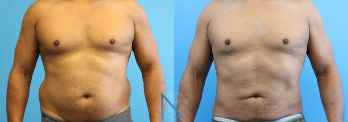 Before & After Male Liposuction Case 163 View 1 View in Raleigh, NC