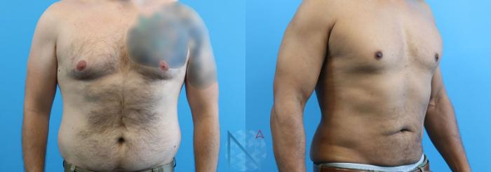 Before & After Male Liposuction Case 163 View 2 View in Raleigh, NC