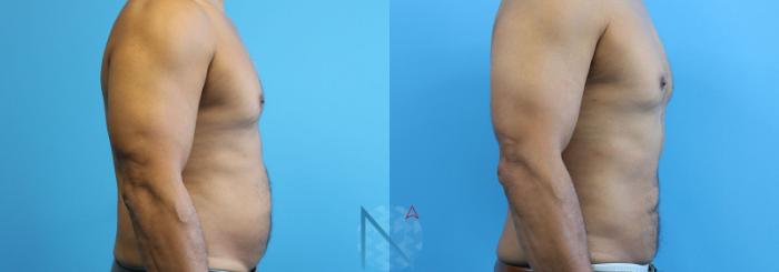 Before & After Male Liposuction Case 163 View 3 View in Raleigh, NC