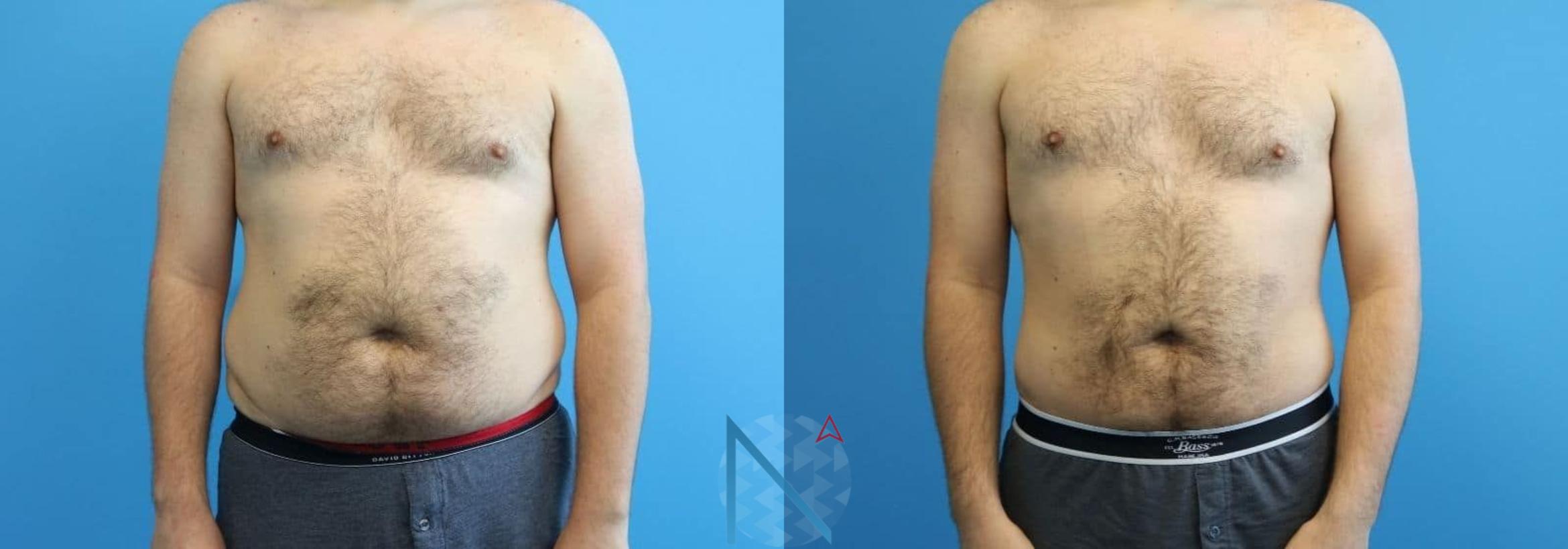 Before & After Male Liposuction Case 164 View 1 View in Raleigh, NC