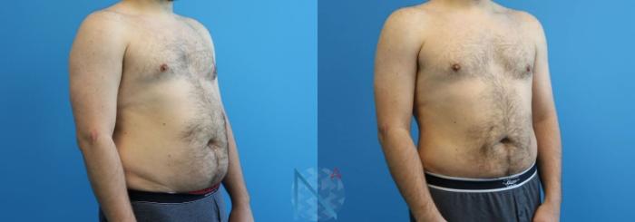 Before & After Male Liposuction Case 164 View 2 View in Raleigh, NC