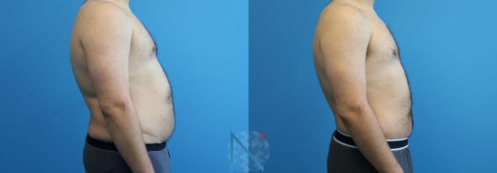 Before & After Male Liposuction Case 164 View 3 View in Raleigh, NC