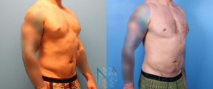 Before & After Male Liposuction Case 166 View 2 View in Raleigh, NC