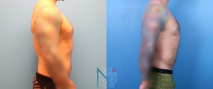 Before & After Male Liposuction Case 166 View 3 View in Raleigh, NC